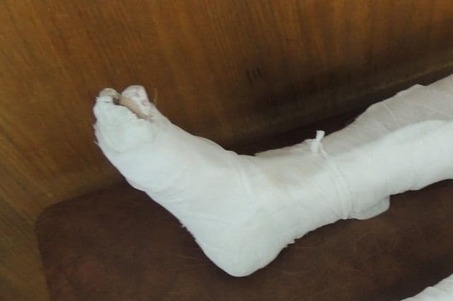 В Стерлитамаке рабочий сломал ногу когда косил траву