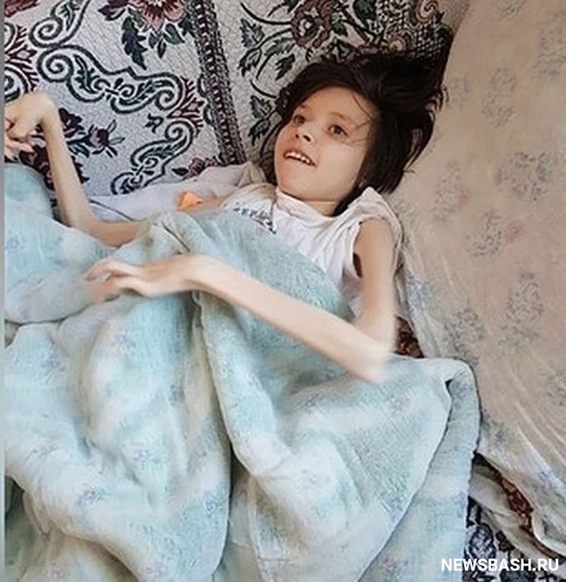 В Башкирии скончалась 21-летняя Люба Клевец, которая всю жизнь провела в кровати из-за прививки