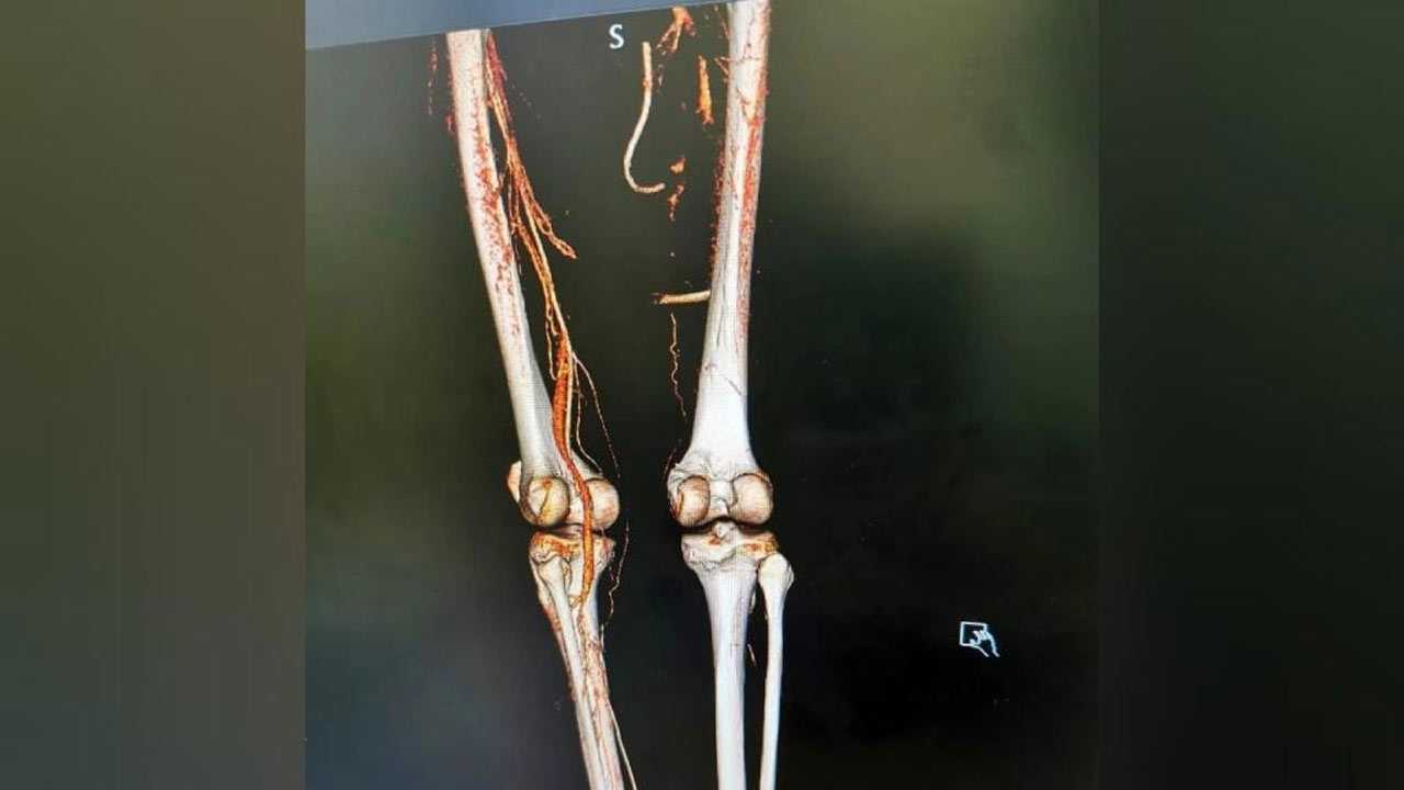 В Башкирии врачи спасли от ампутации ногу  пациенту
