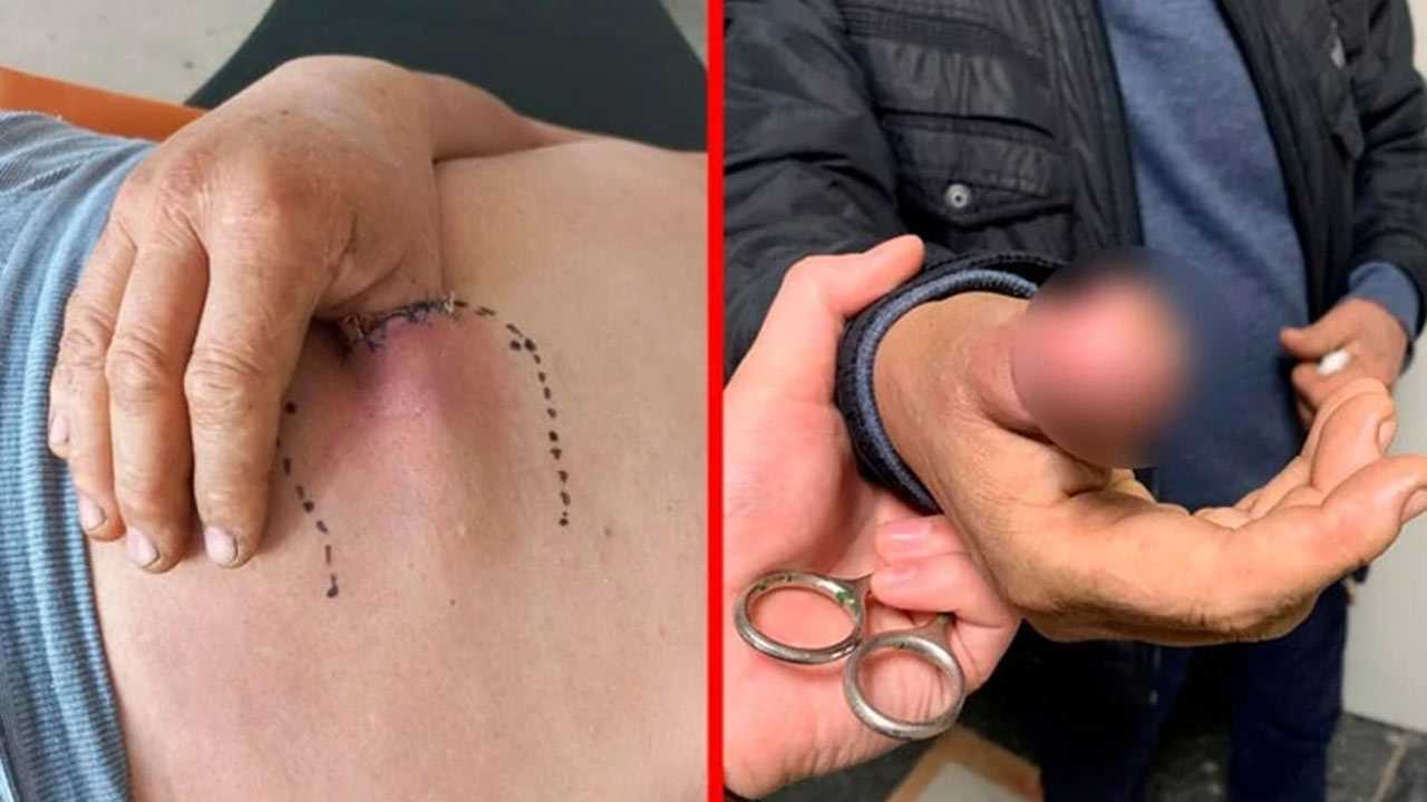 В Стерлитамаке хирурги спасли изувеченный палец токаря, вживив его в живот пациента