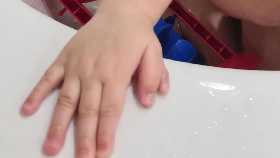 В Уфе хирурги удалили 10-месячному малышу шестой палец на руке