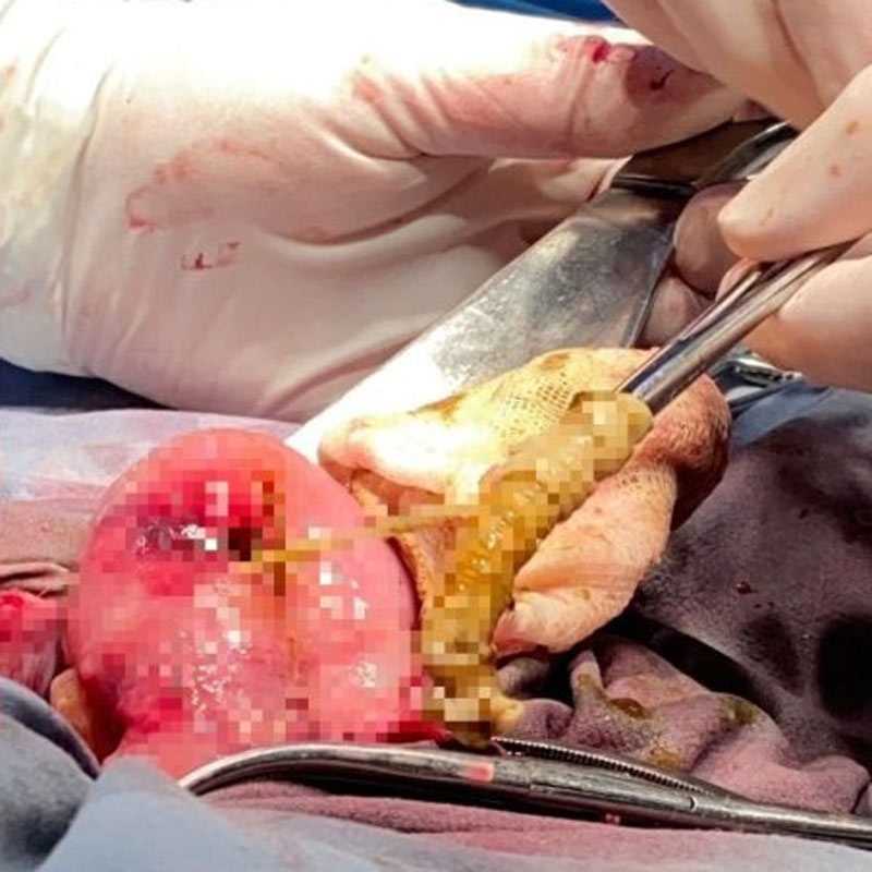 «Рос в организме несколько лет»: уфимские хирурги обнаружили в кишке у пациента 120-сантиметрового червя