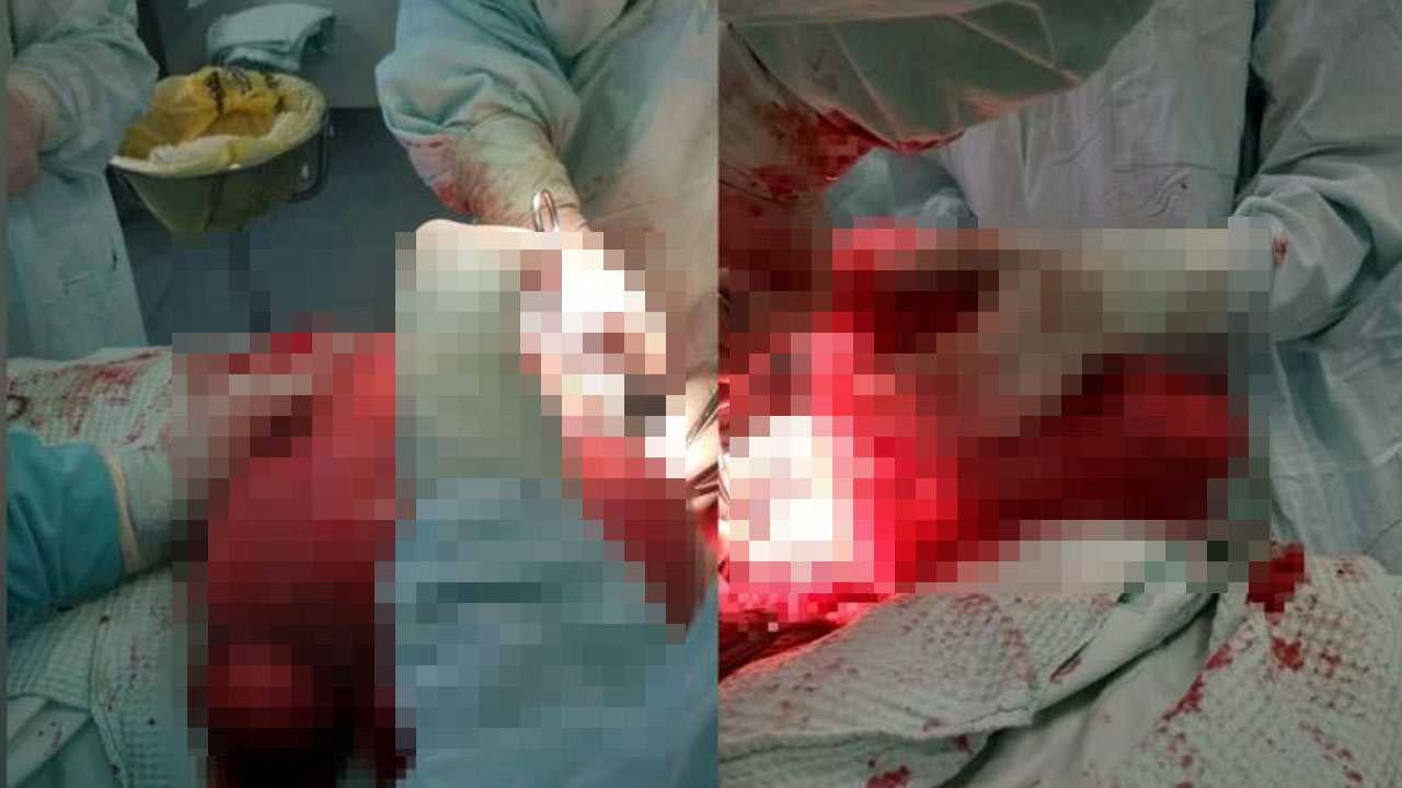 Уфимские врачи удалили женщине 10-килограммовую миому матки