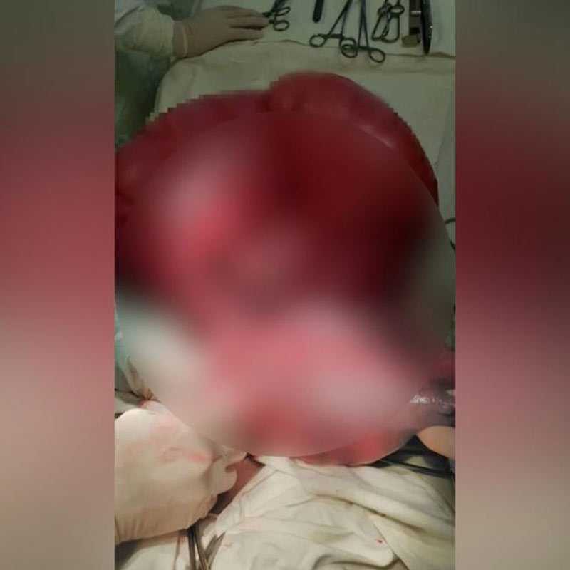 В Башкирии прооперировали мужчину с аномально раздувшимся кишечником
