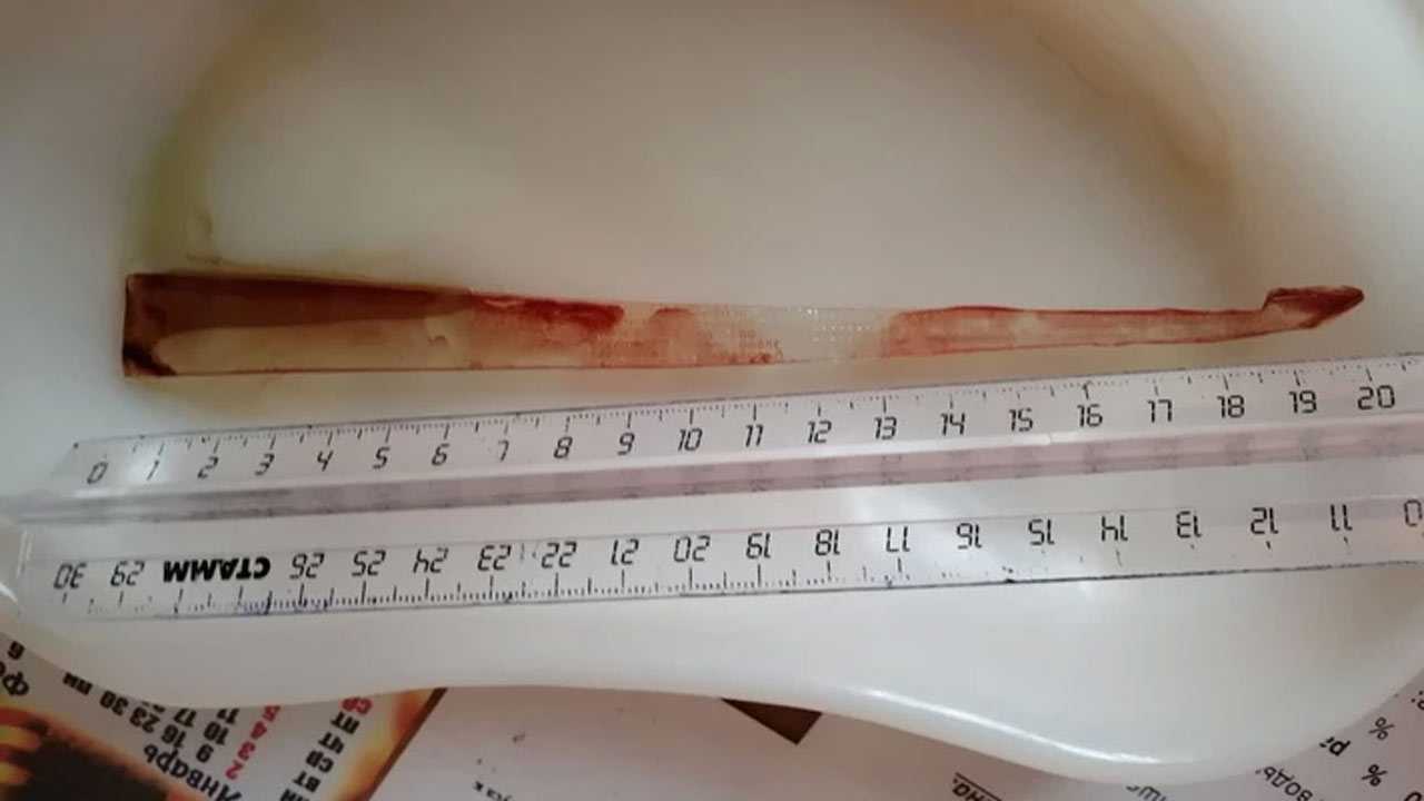 В Башкирии девочке проткнул грудную клетку 21-сантиметровый осколок стекла