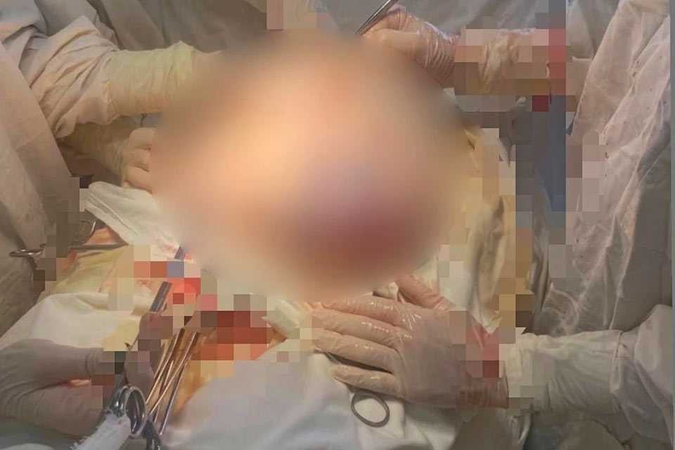 Жительнице Башкирии удалили опухоль яичника с 10 литрами жидкости