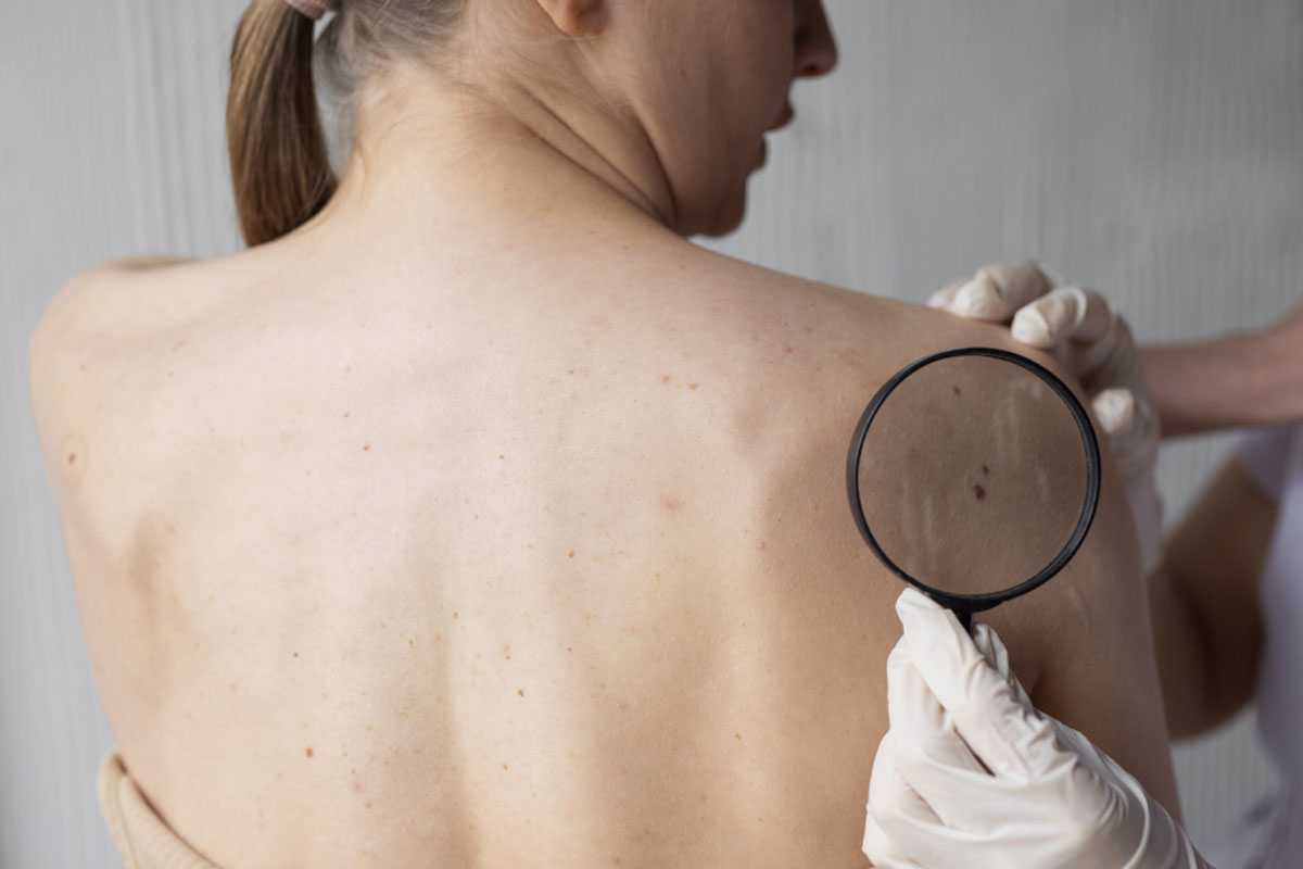 «Можно ли удалять родинки?»: Онколог назвала 7 основных способов профилактики рака кожи