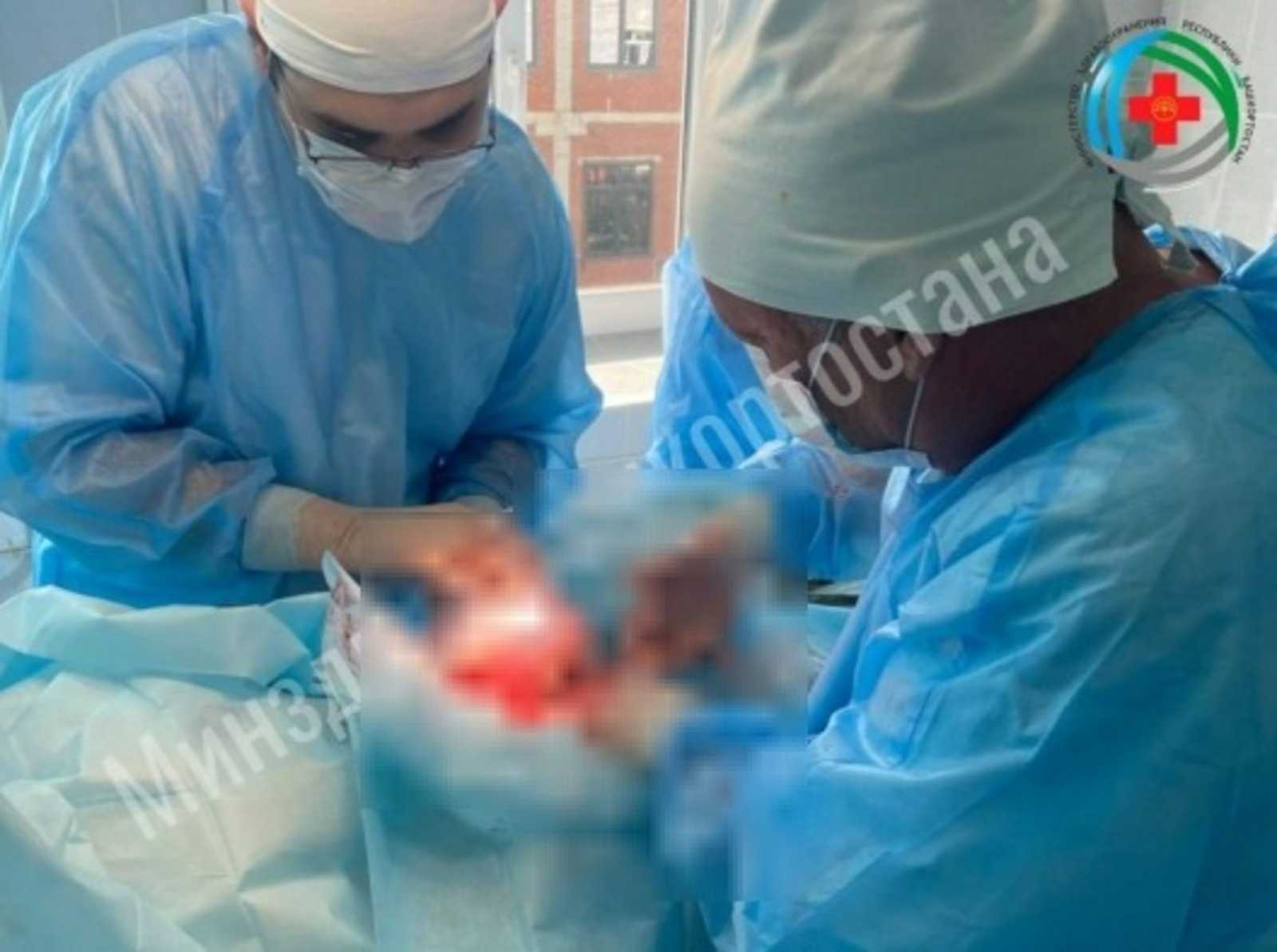 В Башкирии хирурги прооперировали женщину с кистой размером с дыню