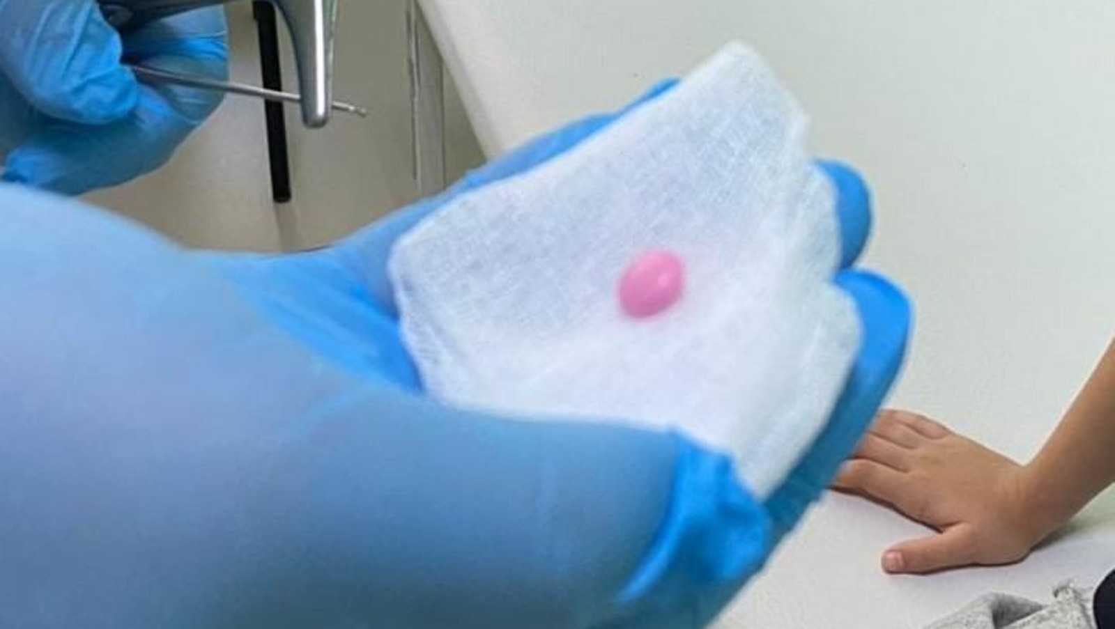 В Башкирии врачи спасли девочку, засунувшую в нос таблетку