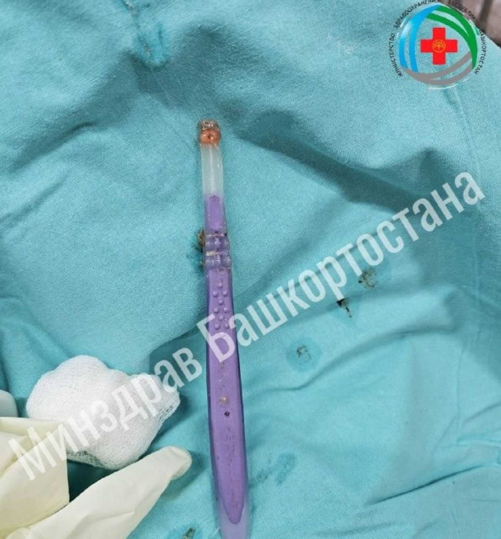 Уфимские врачи спасли мужчину, который проглотил зубную щетку