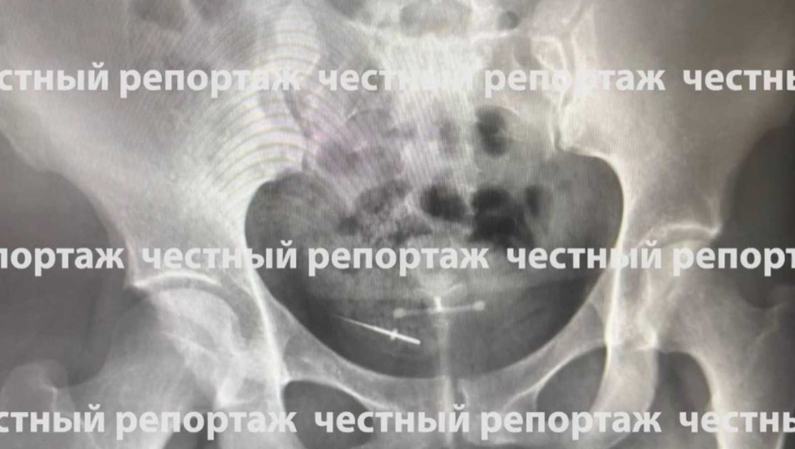 В Башкирии врач забыл иглу во рту пациентки — инструмент оказался в кишечнике