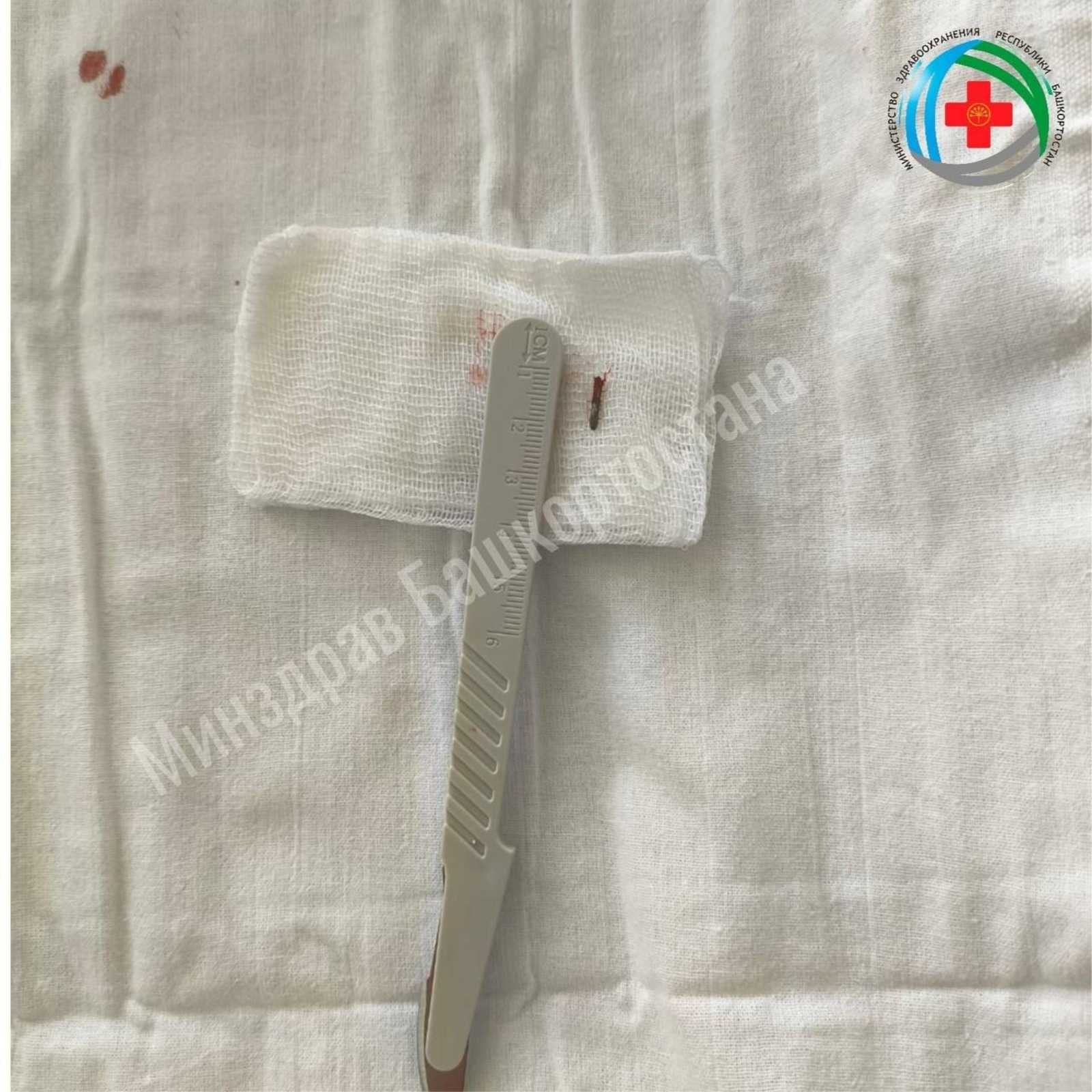 Врачи в Башкирии спасли женщину, в шею которой отлетела проволока от триммера