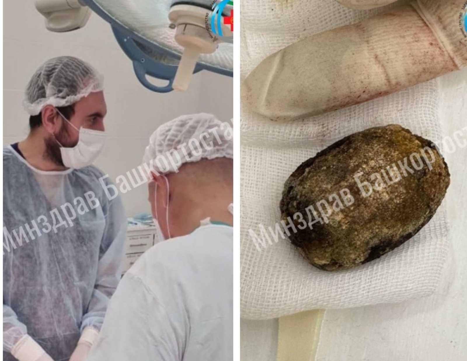 В Башкирии прооперировали женщину с камнем в желчном пузыре размером с яйцо