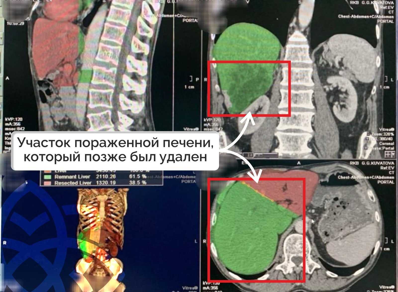 Башкирские врачи «вырастили» печень пациенту с раком