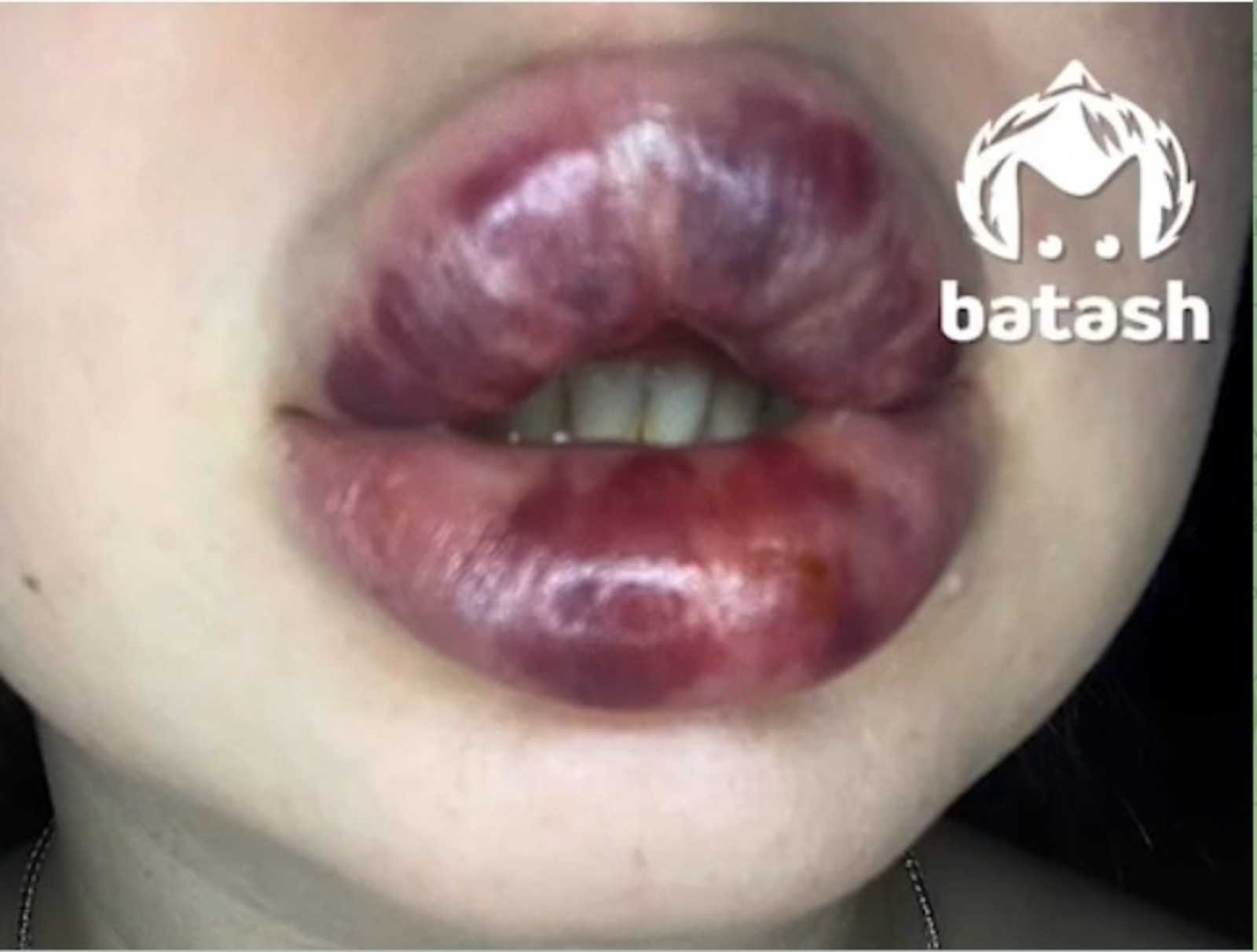 Уфимка получила жуткую гематому после увеличения губ в косметологической клинике