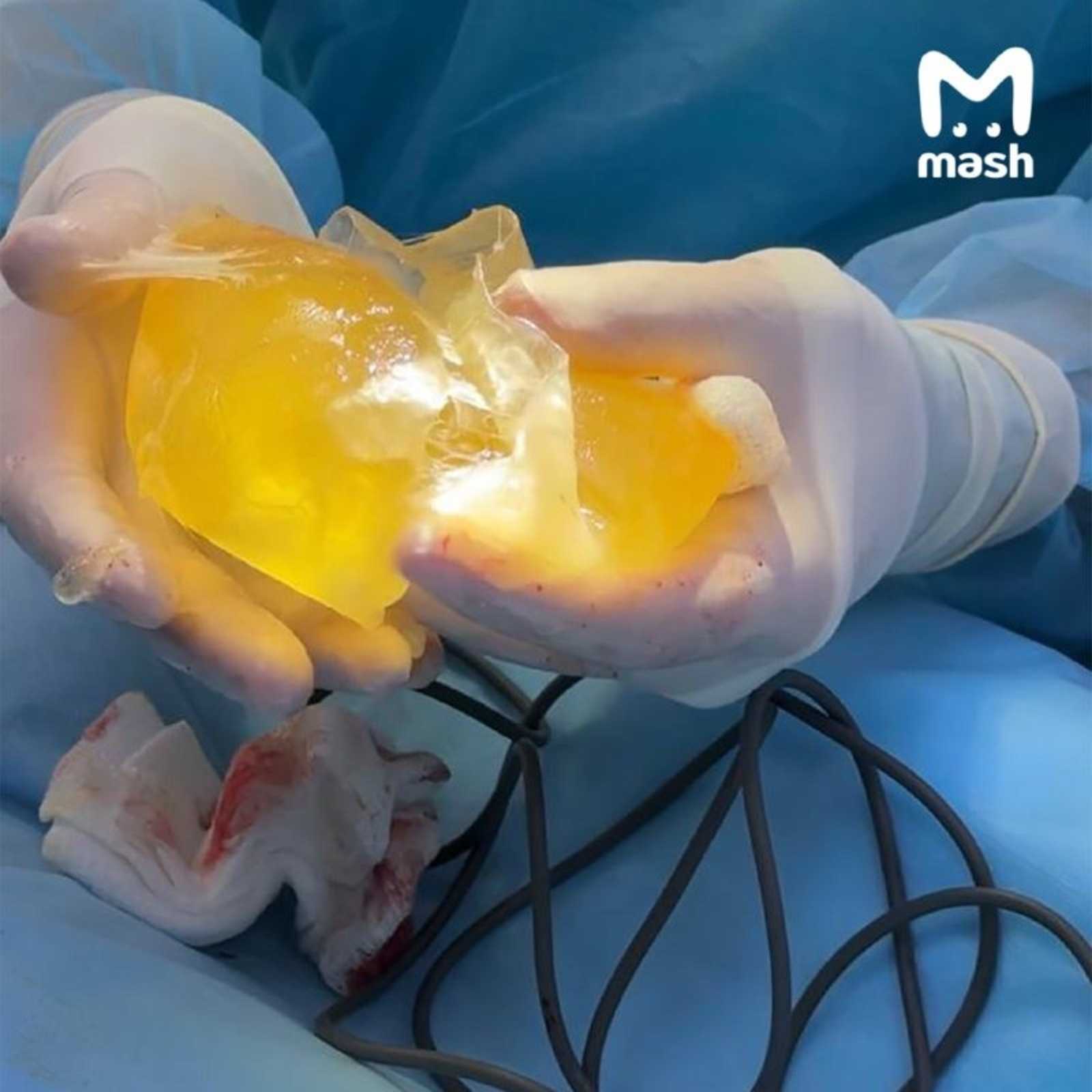 В Уфе у девушки во время тренировки лопнул грудной имплант