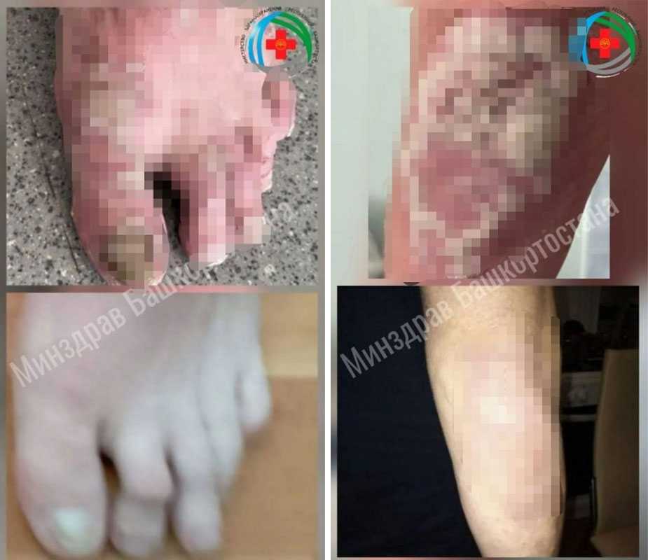 В Уфе генно-инженерный препарат помог победить тяжёлую форму псориатического артрита