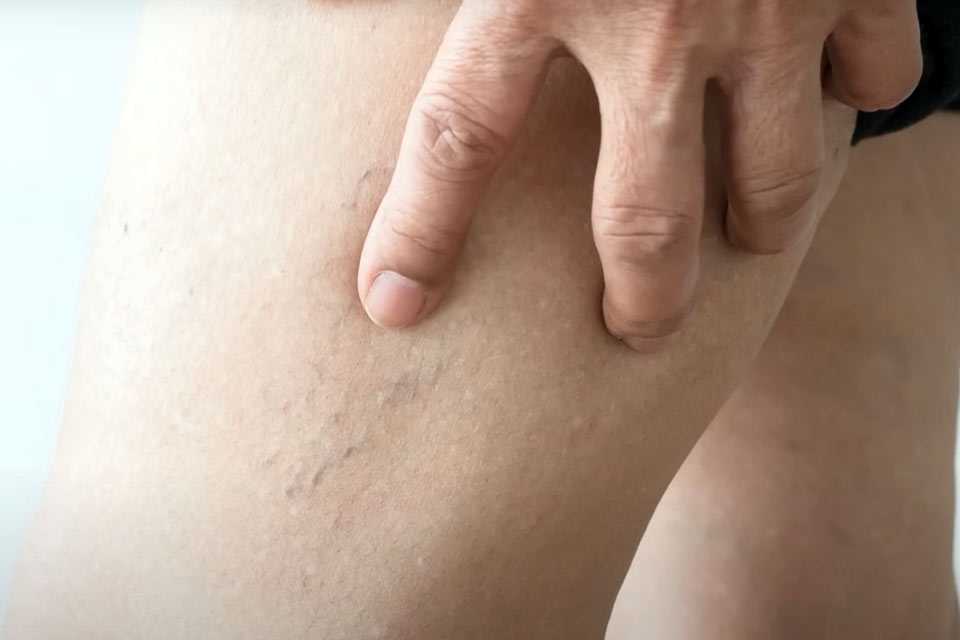 Неожиданная связь: как тромбы могут указывать на онкозаболевания